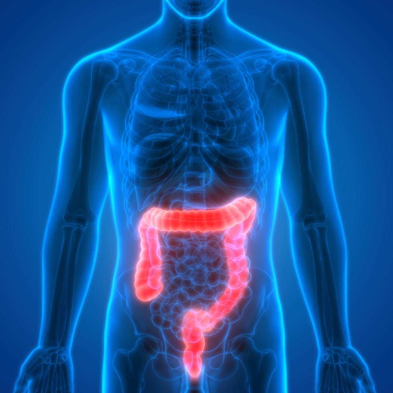 maintrac® for colorectal cancer (carcinoma of the colon)